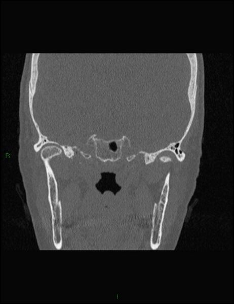 File:Bilateral frontal mucoceles (Radiopaedia 82352-96454 Coronal 265).jpg