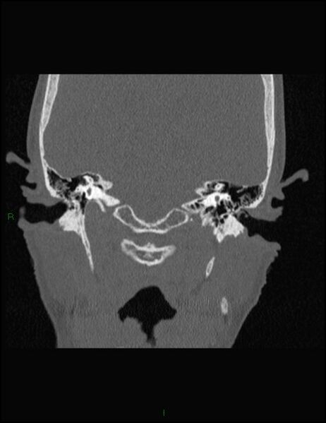 File:Bilateral frontal mucoceles (Radiopaedia 82352-96454 Coronal 312).jpg