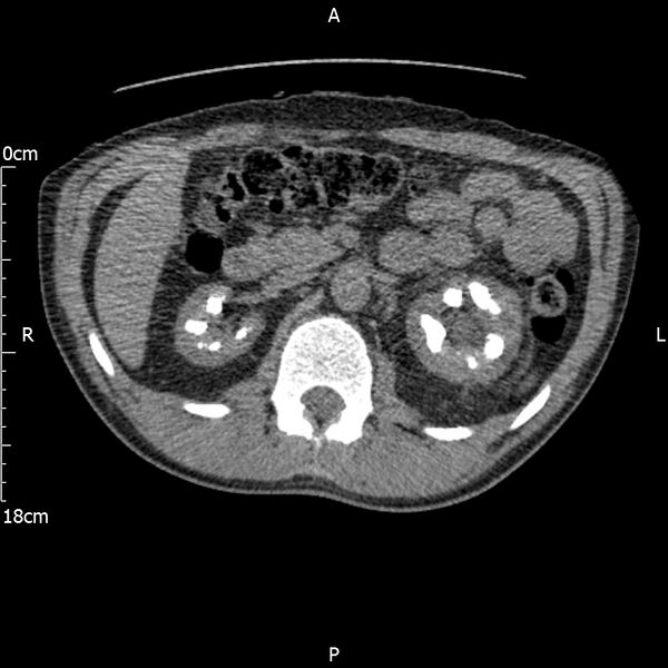 File:Bilateral medullary nephrocalcinosis with ureteric calculi (Radiopaedia 71269-81569 Axial non-contrast 39).jpg