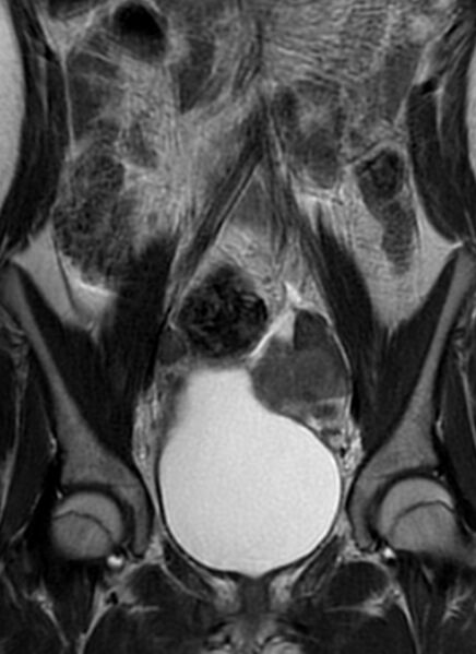 File:Bilateral ovarian fibrothecomas - adolescent (Radiopaedia 86604-102707 Coronal T2 15).jpg