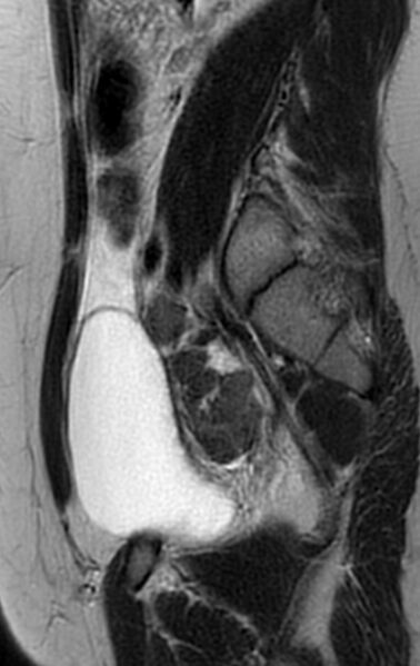 File:Bilateral ovarian fibrothecomas - adolescent (Radiopaedia 86604-102707 Sagittal T2 10).jpg