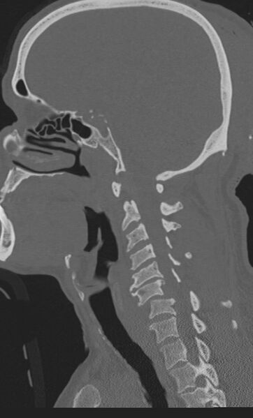 File:Bilateral perched facet joint (Radiopaedia 63149-71669 Sagittal bone window 38).jpg