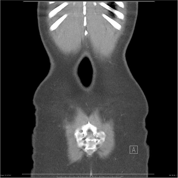 File:Bilateral ureteritis and cystitis (Radiopaedia 25340-25594 B 37).jpg