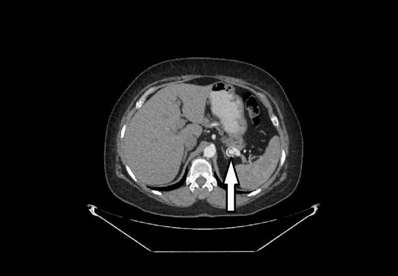 File:Bilateral urolithiasis with incidentally detected splenic artery aneurysm and left inferior vena cava (Radiopaedia 44467-48130 Mutiple 1).jpg