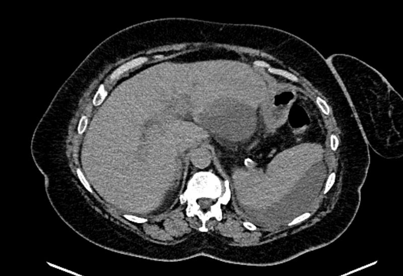 File:Biliary pancreatitis (Radiopaedia 72289-82823 Axial non-contrast 71).jpg