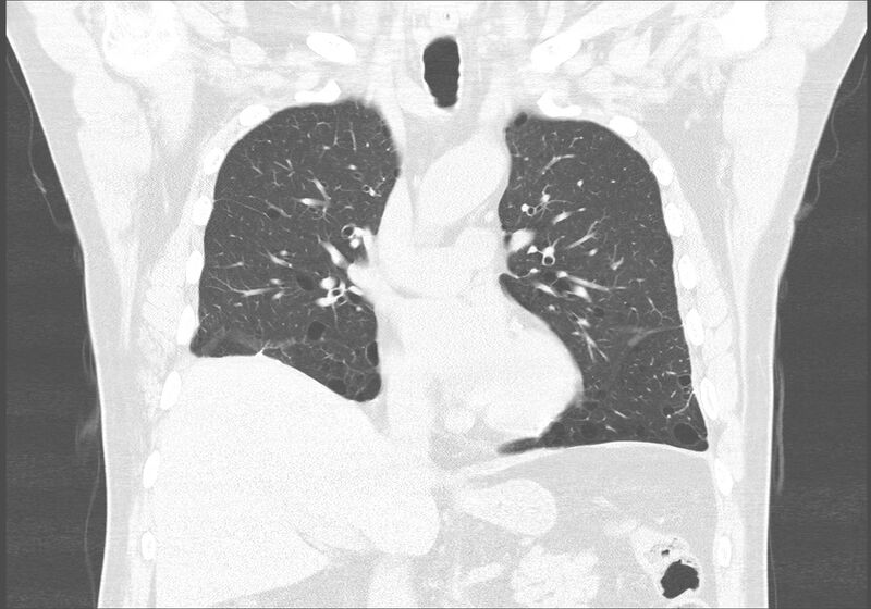 File:Birt-Hogg-Dubé syndrome (Radiopaedia 52578-58491 Coronal lung window 24).jpg