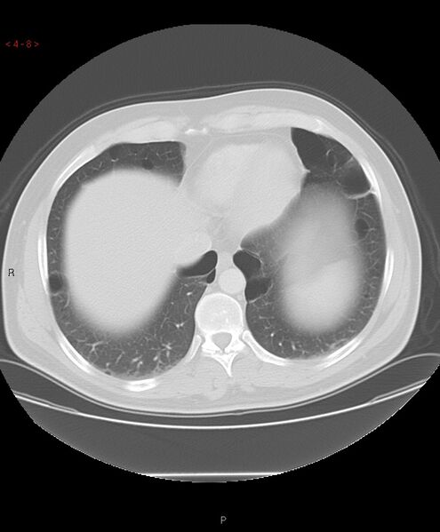 File:Birt-Hogg-Dubé syndrome (Radiopaedia 53814-60013 Axial lung window 8).jpg