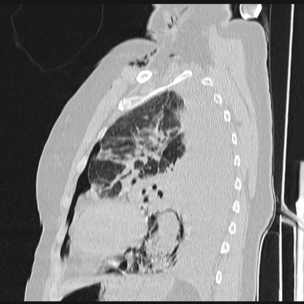 File:Boerhaave syndrome (Radiopaedia 45644-49799 Sagittal lung window 59).jpg
