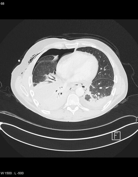 File:Boerhaave syndrome with tension pneumothorax (Radiopaedia 56794-63605 Axial lung window 33).jpg