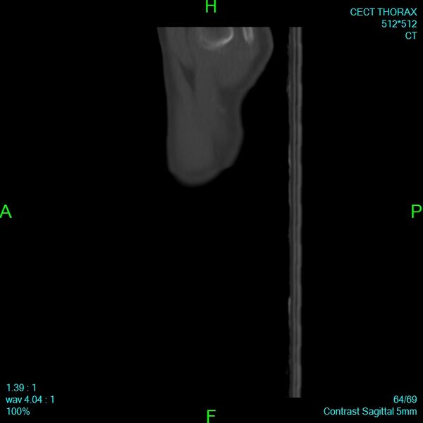 File:Bone metastases from lung carcinoma (Radiopaedia 54703-60937 Sagittal bone window 64).jpg