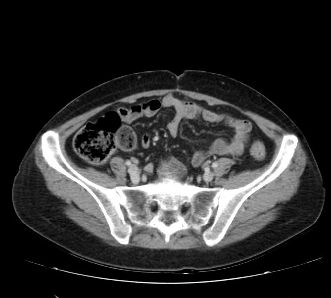 File:Bosniak renal cyst - type IV (Radiopaedia 22929-22953 C 49).jpg