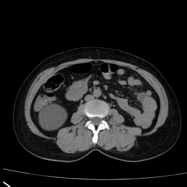 File:Bosniak renal cyst - type I (Radiopaedia 27479-27675 Axial non-contrast 49).jpg