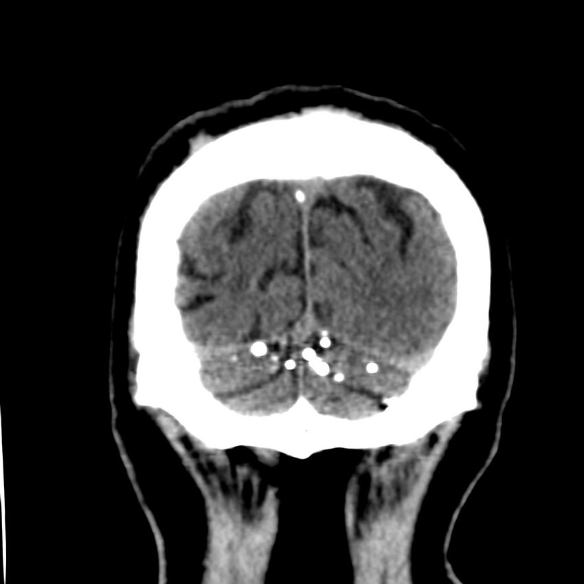 Brain Pantopaque remnants (Radiopaedia 78403-91048 Coronal non-contrast 63).jpg