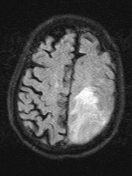 File:Brain abscess with dual rim sign (Radiopaedia 87566-103938 Axial FLAIR 18).jpg