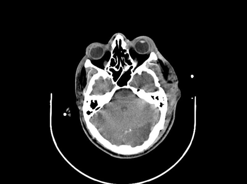 File:Brain injury by firearm projectile (Radiopaedia 82068-96087 B 72).jpg