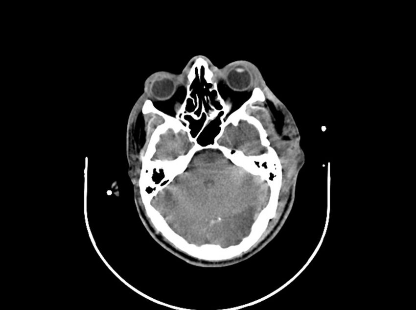 Brain injury by firearm projectile (Radiopaedia 82068-96087 B 72).jpg