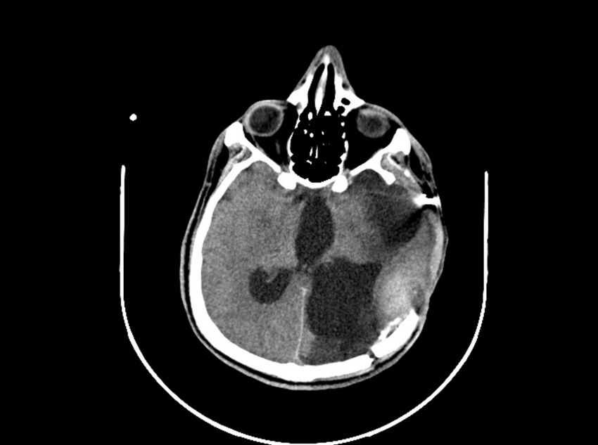 Brain injury by firearm projectile (Radiopaedia 82068-96088 A 122).jpg