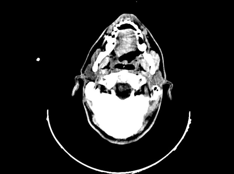 File:Brain injury by firearm projectile (Radiopaedia 82068-96088 A 58).jpg