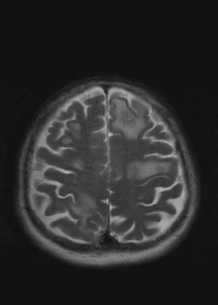 File:Brain metastases from squamocellular lung cancer (Radiopaedia 56515-63222 Axial T2 20).jpg