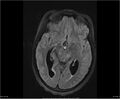 Brainstem glioma (Radiopaedia 21819-21775 Axial FLAIR 18).jpg