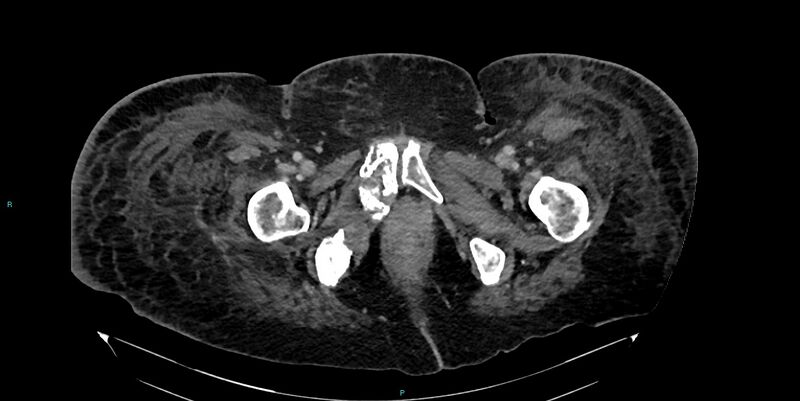 File:Breast cancer pelvic bony metastases (Radiopaedia 84470-99824 Axial bone window 72).jpg