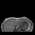 Breast implants - MRI (Radiopaedia 26864-27035 Axial T1 1).jpg