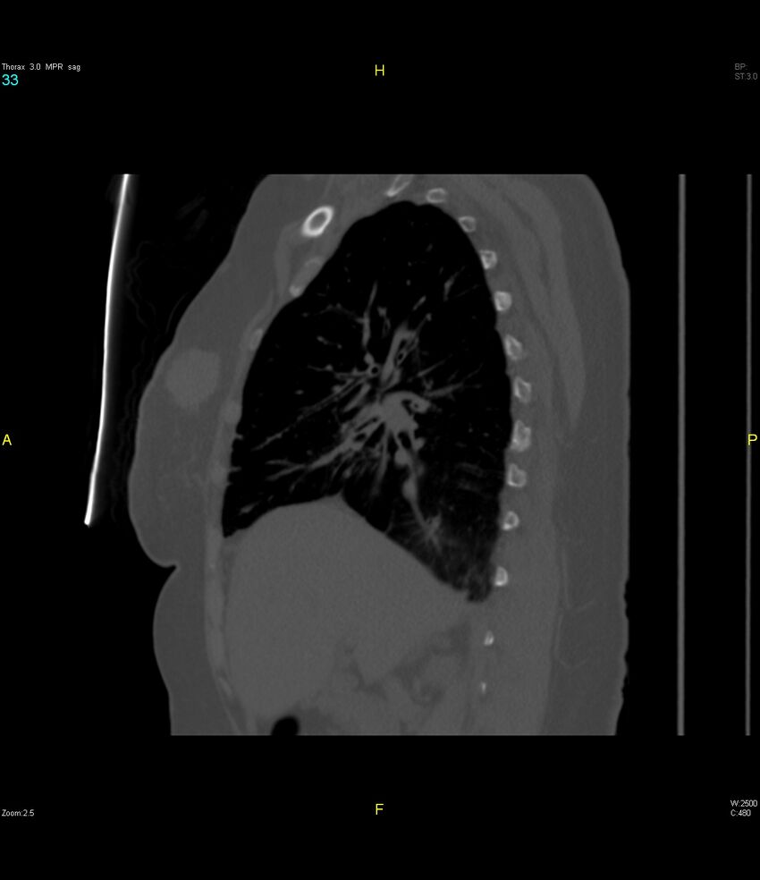 Breast primary with lung and bone metastases (Radiopaedia 40620-43228 Sagittal bone window 33).jpg