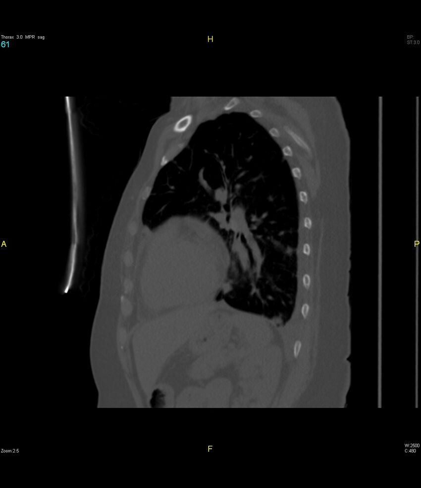 Breast primary with lung and bone metastases (Radiopaedia 40620-43228 Sagittal bone window 61).jpg