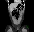 Broad ligament hernia (Radiopaedia 63260-71832 B 6).jpg