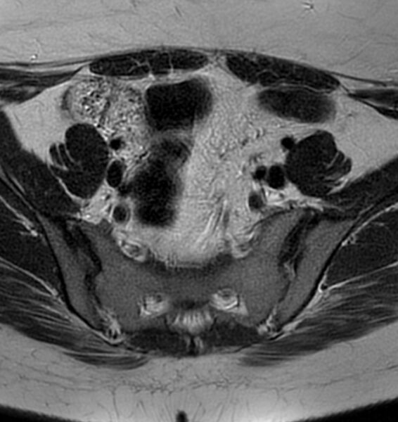 File:Broad ligament leiomyoma (Radiopaedia 81634-95516 Axial T2 5).jpg