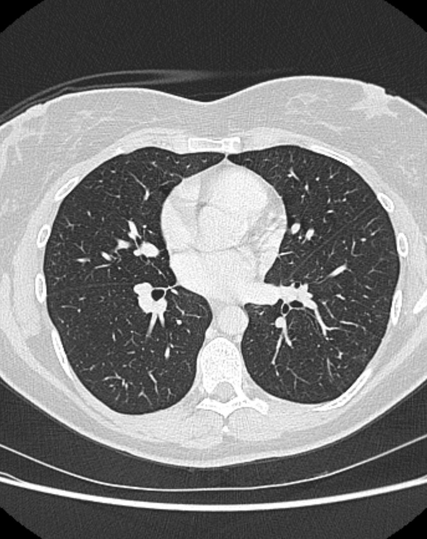 Bronchial atresia (Radiopaedia 50007-55297 Axial lung window 58).jpg
