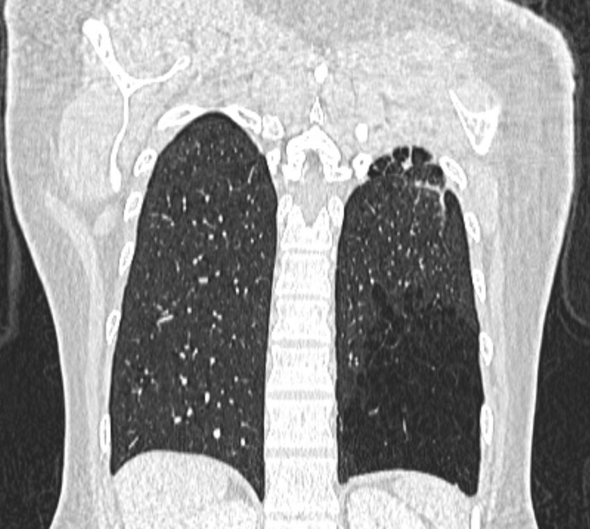 Bronchial atresia (Radiopaedia 50007-55297 Coronal lung window 97).jpg