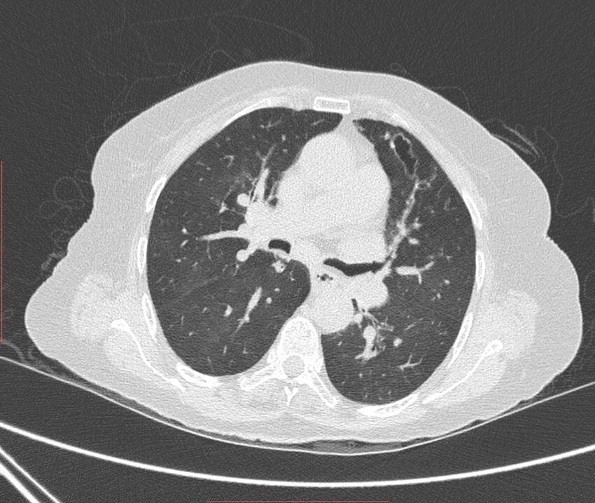 Bronchiectasis (Radiopaedia 72693-83293 Axial lung window 58).jpg