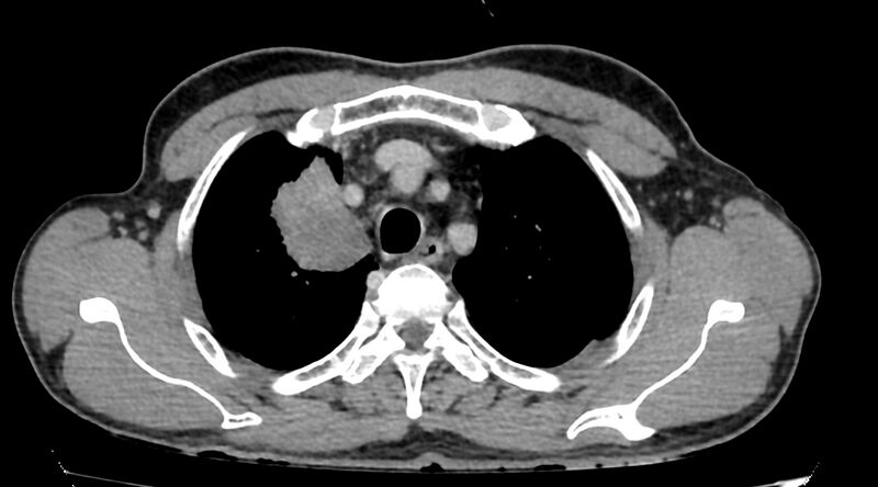 File:Bronchogenic carcinoma with superior vena cava syndrome (Radiopaedia 36497-38054 Axial C+ delayed 17).jpg