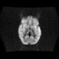 Burkitt lymphoma of the orbit- pre and post chemotherapy (Radiopaedia 31214-31930 Axial DWI 9).jpg
