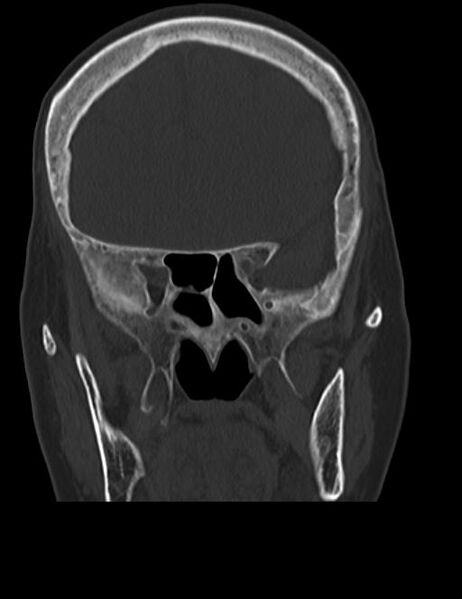 File:Burnt-out meningioma (Radiopaedia 51557-57337 Coronal bone window 17).jpg