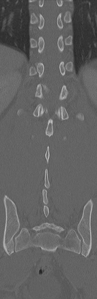 File:Burst fracture - T12 with conus compression (Radiopaedia 56825-63647 Coronal bone window 29).png