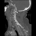 C1 anterior arch (plough) fracture - type 1 (Radiopaedia 76181-87720 Sagittal bone window 46).jpg