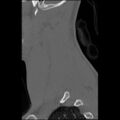 C5 facet fracture (Radiopaedia 58374-65499 Sagittal bone window 58).jpg