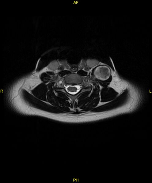 File:C5 nerve sheath tumor (Radiopaedia 85777-101596 Axial T2 48).jpg