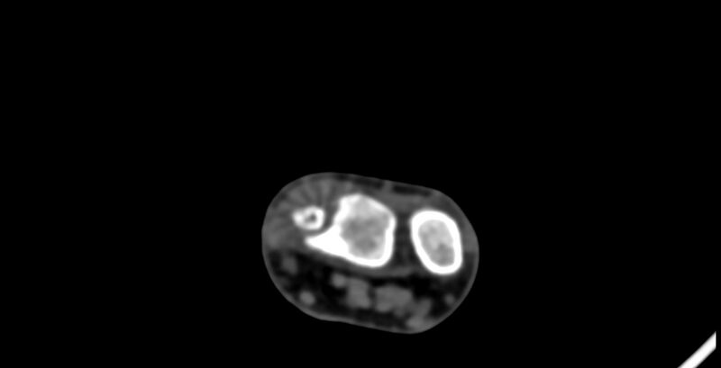 File:Calcifying aponeurotic fibroma (Radiopaedia 88423-105064 B 19).jpg