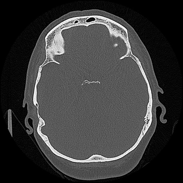 File:Canal up mastoidectomy (Radiopaedia 78108-90638 Axial bone window 118).jpg