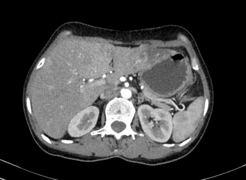 File:Cannonball metastases from breast cancer (Radiopaedia 91024-108569 A 124).jpg