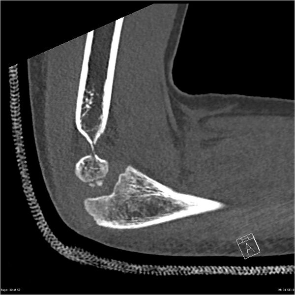 File:Capitellum fracture (Radiopaedia 23352-23426 Sagittal bone window 30).jpg
