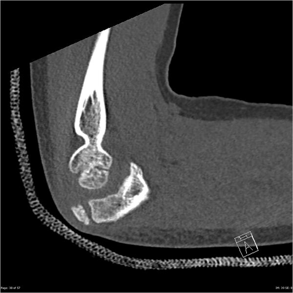 File:Capitellum fracture (Radiopaedia 23352-23426 Sagittal bone window 38).jpg