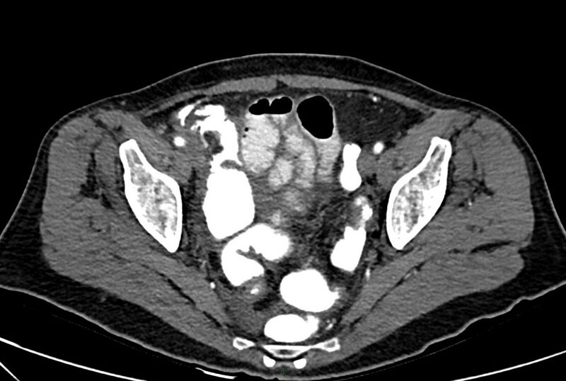 File:Carcinoid mesenteric tumor complicated by chylous ascites (Radiopaedia 76312-88926 A 65).jpg
