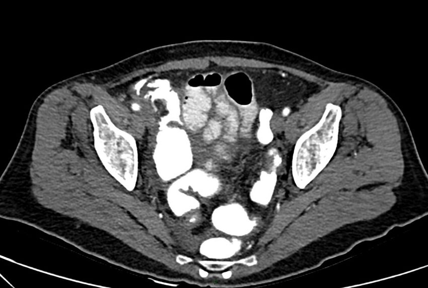 Carcinoid mesenteric tumor complicated by chylous ascites (Radiopaedia 76312-88926 A 65).jpg