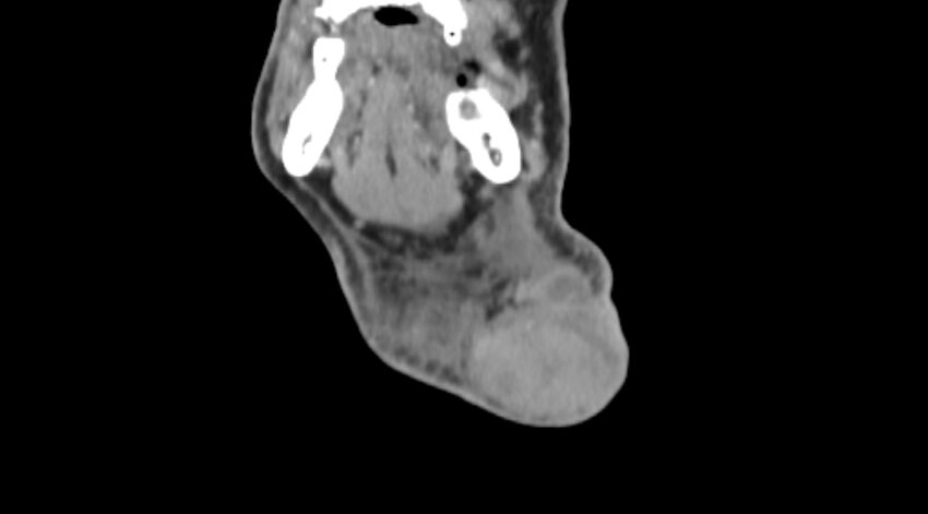 Carotid artery pseudoaneurysm (Radiopaedia 84030-99259 D 4).jpg