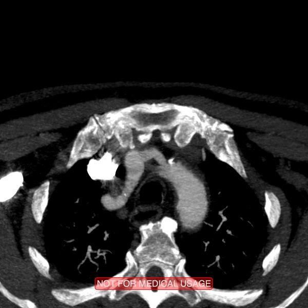 File:Carotid artery stenosis (Radiopaedia 28786-29086 C 29).jpg