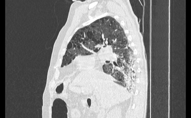 File:Cavitating bronchogenic carcinoma (Radiopaedia 44489-48162 Sagittal lung window 18).jpg